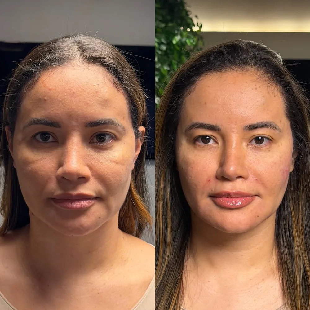 Antes e depois de harmonização facial na Schultz Estética