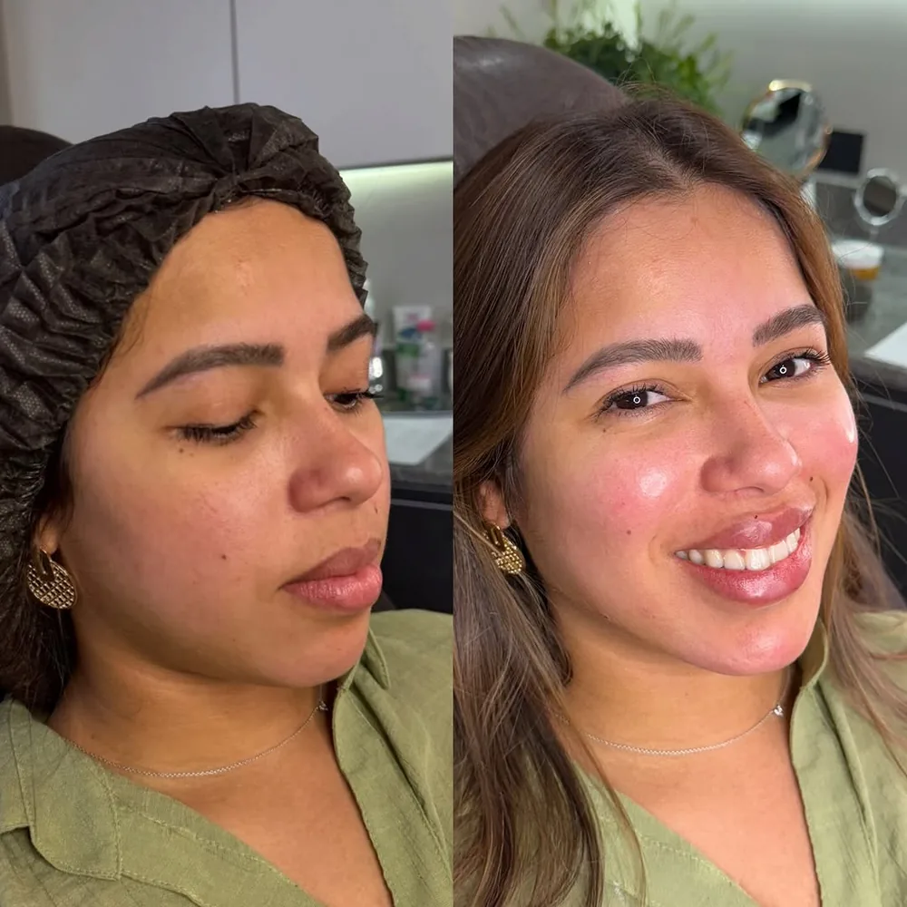 Antes e depois de harmonização facial na Schultz Estética