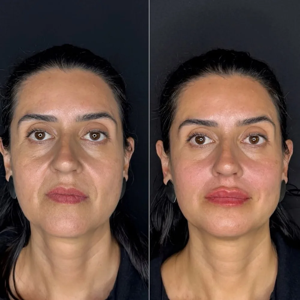 Resultado de preenchimento labial na Schultz Estética
