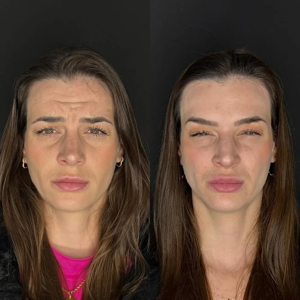 Antes e depois de aplicação de botox na Schultz Estética