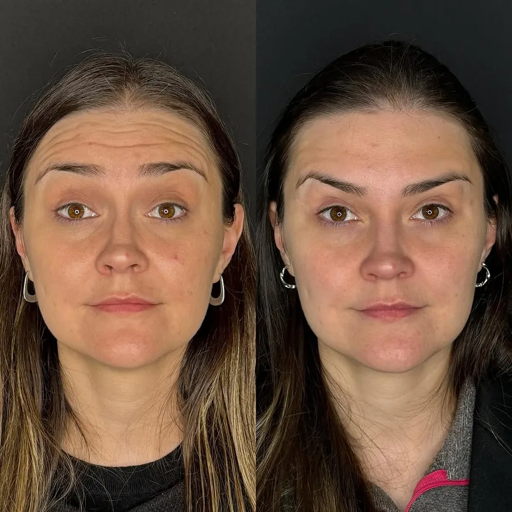 Antes e depois de harmonização facial na Schultz Estética