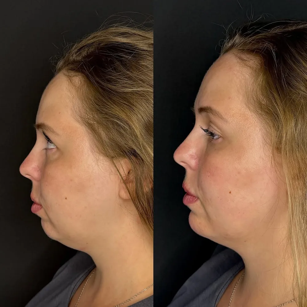 Antes e depois de contorno facial na Schultz Estética